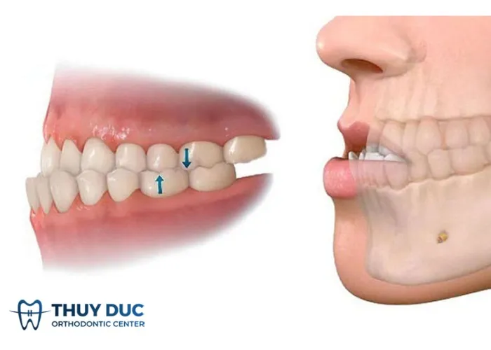 Khớp cắn ngược có thể gây ra tình trạng mặt lưỡi cày