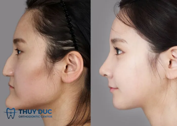 Phẫu thuật giúp khôi phục tính thẩm mỹ cho khuôn mặt lưỡi cày (móm do xương)