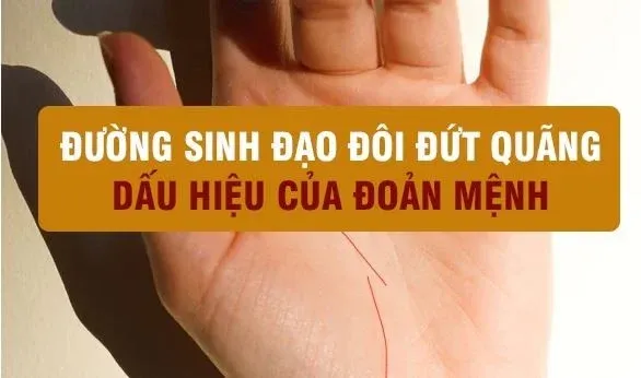 Bàn tay với đường sinh đạo đôi bị đứt đoạn ở nhiều chỗ
