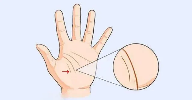 Bàn tay hiển thị đường sinh đạo đôi ngắn và không rõ ràng