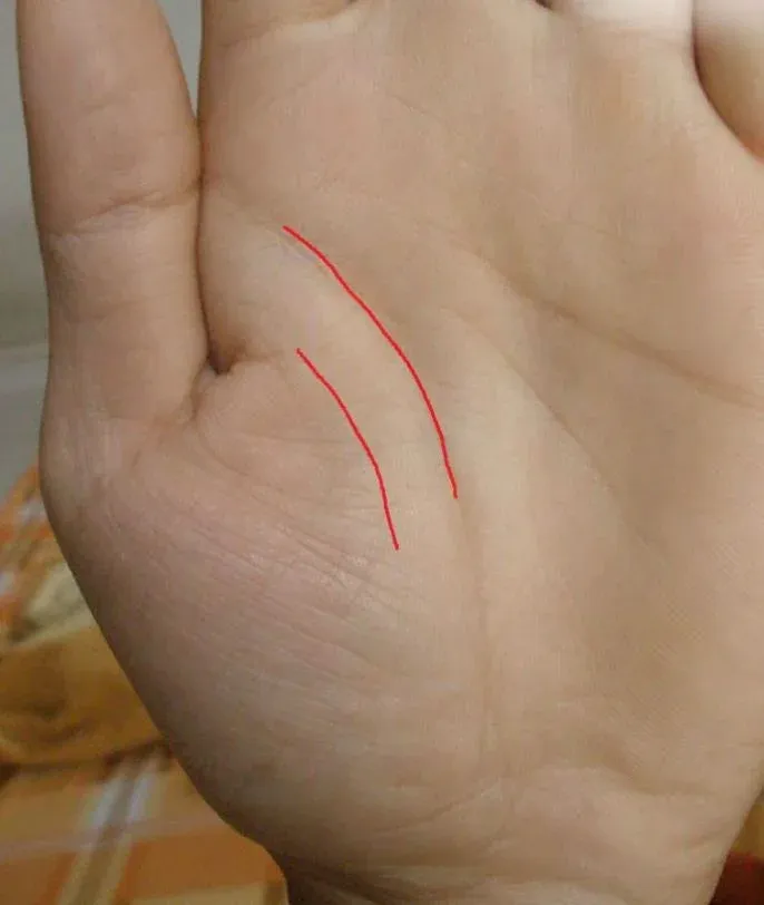 Hình ảnh minh họa vị trí đường sinh đạo đôi trên lòng bàn tay