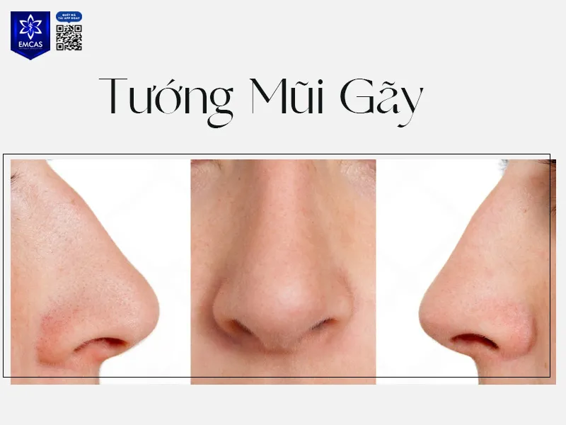Tướng mũi gãy với sống mũi không liền mạch, gây mất hài hòa cho khuôn mặt
