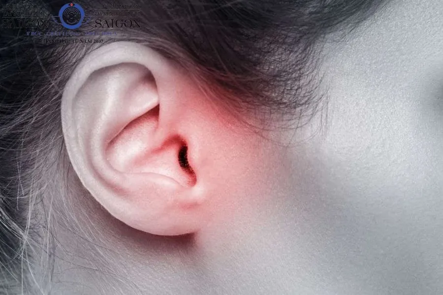 Ù tai phải là cảm giác nghe tiếng lạ ở phía tai phải dù không có âm thanh thật